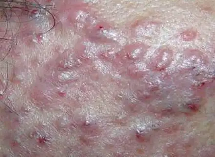 结节囊肿型痤疮图片