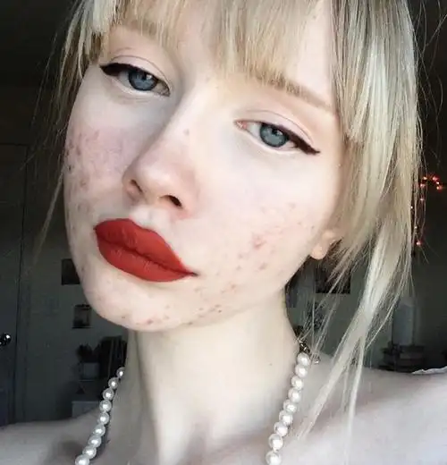 美国女孩满脸粉刺仍自信展现缺陷美