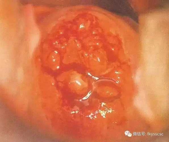 多图示例镜下6种异常宫颈图像的解读值得收藏