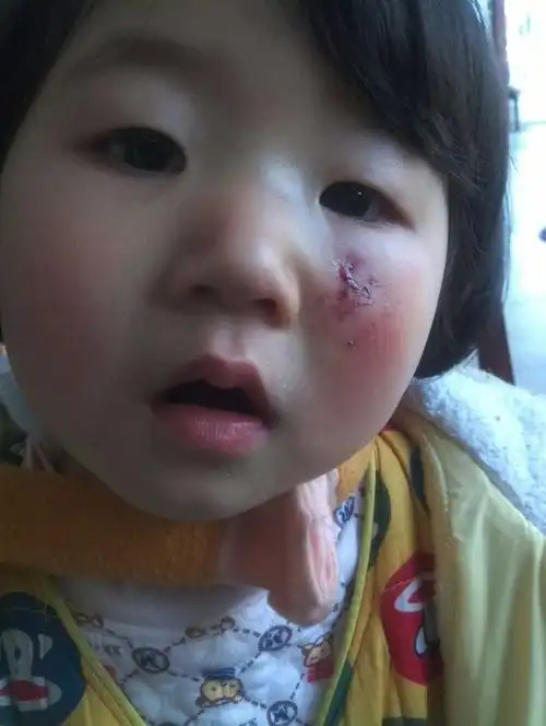 [幼儿园的故事]烊宝被幼儿园的小朋友咬了.