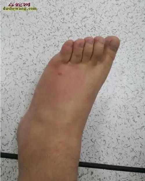 被蜈蚣咬了伤口图片蜈蚣咬伤是什么样子的