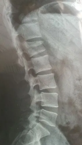 腰椎1压缩骨折必须手术吗?现在身体活动正常,大小便正常.