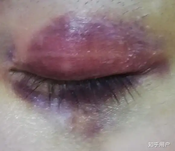 想知道眼部淤青怎么可以快速消除