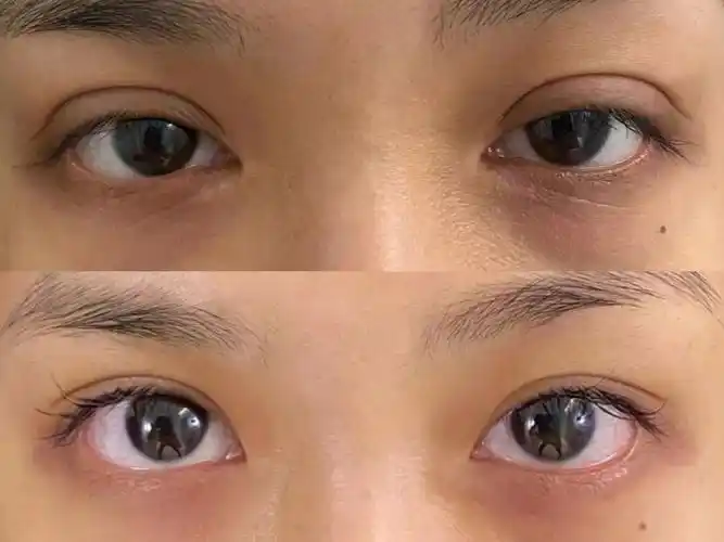 大眼美女赴湘修复双眼皮,术后15天高清反馈,这妈生感太绝了!