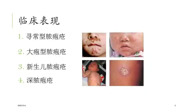 脓疱疮ppt参考幻灯片