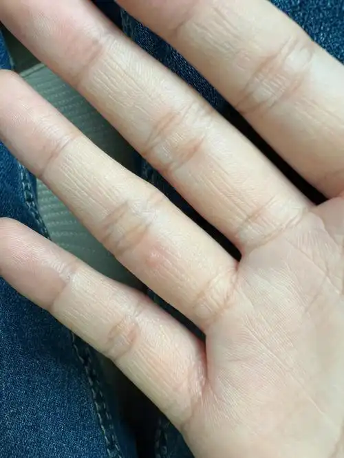 月了……很小一个不痛不痒,然后又长了一个自己查资料说可能是寻常疣