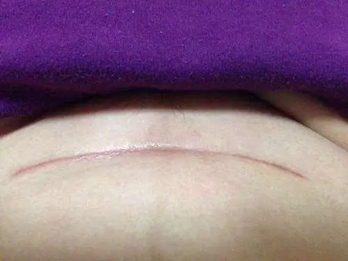 刨腹产刀口图片70