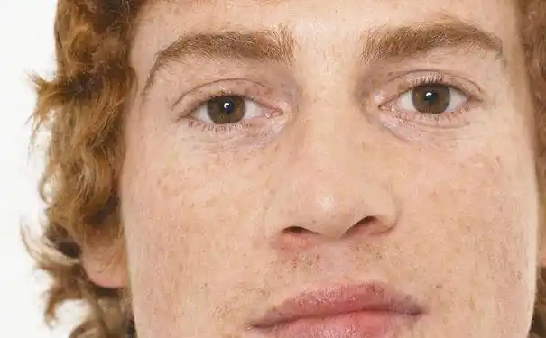 男士雀斑是怎么形成的男士雀斑长成原因图