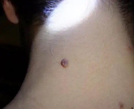 肉痣图片51