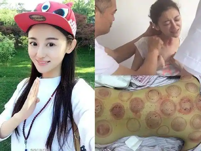 徐婷生前误信拔罐放血抗癌照片曝光
