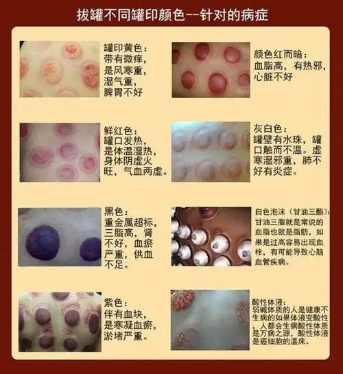 【舜师真空拔罐器生产厂家 拔罐器oem代加工】-山东世纪通医药科技