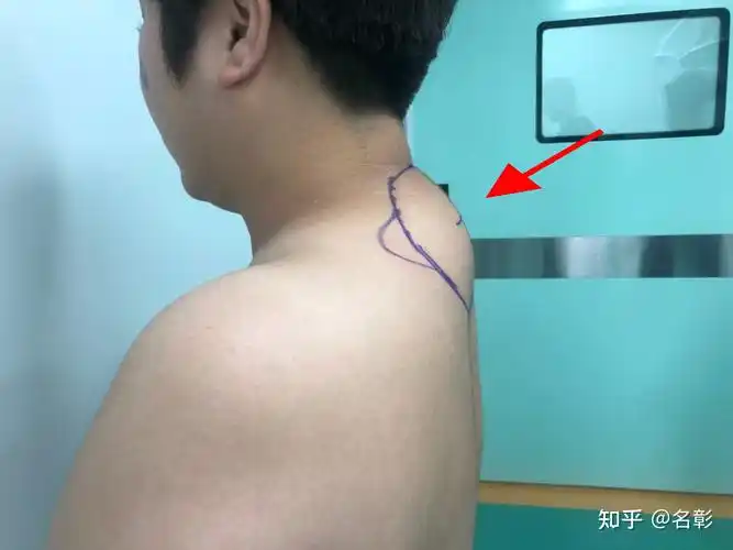 富贵包和瘦肩针