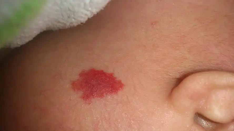 为您推荐: 其他回答 像是血管瘤 高出皮肤就是草莓状的 不高