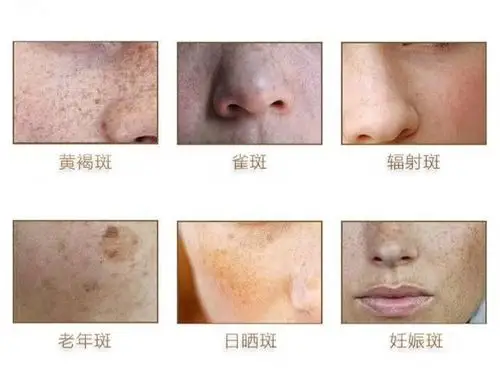 为什么99的女性都在25岁后容易长斑竟然是因为它