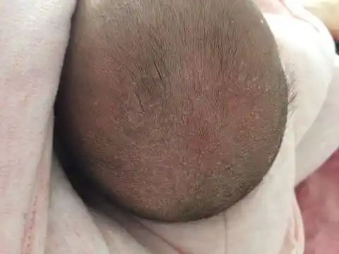 之前还比较少的,昨天洗完澡突然变多了,这是乾燥的还是湿疹还是乳痂?