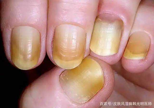 指甲的形状和颜色,能反映身体健康状况!快看看你是哪一种