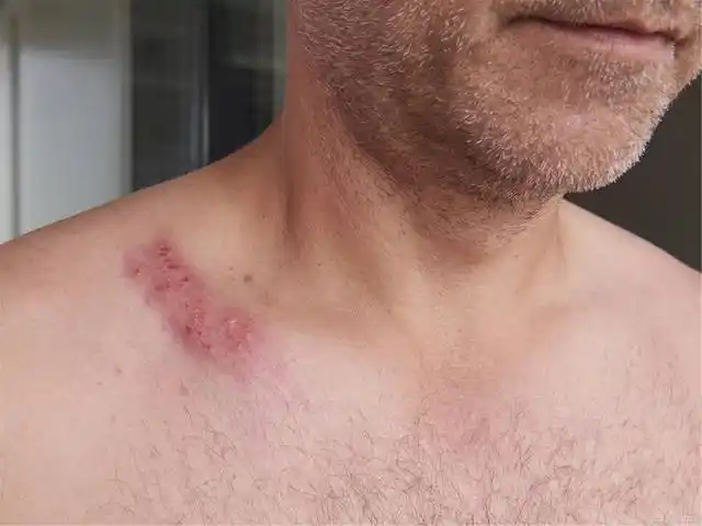 男性也会被hpv"盯上"吗?若已中招,患者有4种应对病毒的选择