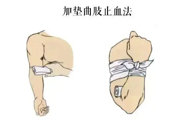 加垫屈肢止血法3方法:根据动脉的走向,用拇指压住出血的血管上方(近心