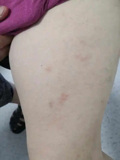 全身瘙痒,双下肢红斑丘疹尤重,瘙痒剧烈.考虑夏季皮炎并发淤积性皮炎.