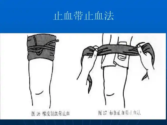 止血带止血法