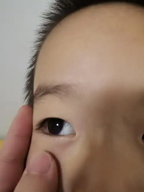 3岁宝宝,倒睫手术哪个医院比较好?