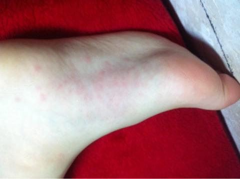 五岁男宝脚底起红点,是手足口病么