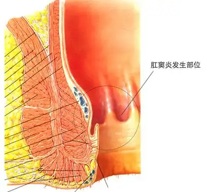 图1-肛窦炎发病部位示意图图2-肛周脓肿发病部位示意图图3-坏死性筋膜