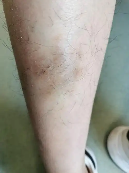 每到冬季皮肤总是干燥长湿疹怎么办