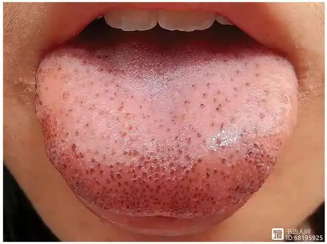 首先,伸出舌头,如果发现舌头上有很明显的瘀点,表明血瘀正在形成;了解