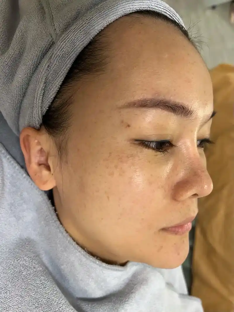 真皮斑:颧骨褐青色痣(真皮层)成因 1,日晒 2,电离子辐射 - 抖音