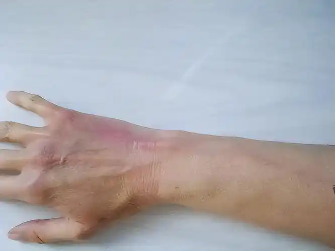 静脉炎的症状有哪些(静脉炎的症状,你了解多少?