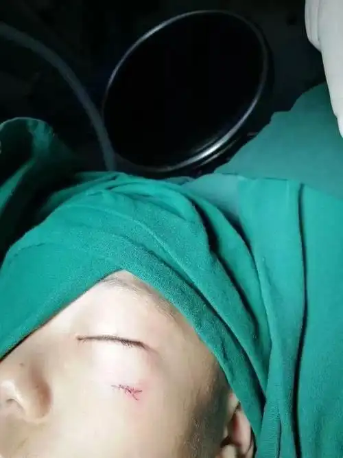 揪心!赣州6岁男童不慎跌倒,铅笔从左脸戳进眼睛