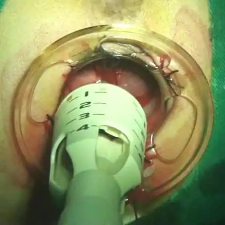 手术视频 痔上黏膜环形切除术