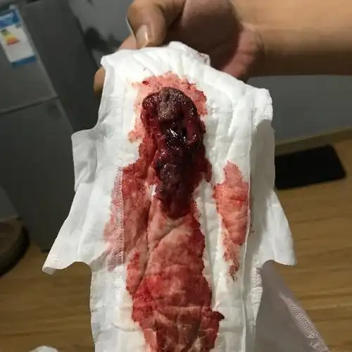 月经期出血图片