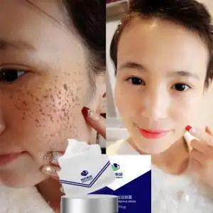 国药儿童祛斑霜小孩子淡斑膏孕妇护肤品美白去雀斑遗传斑日晒斑