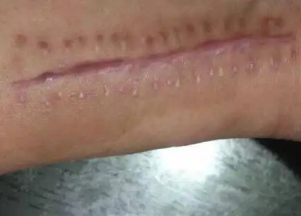 手术疤痕能不能治好
