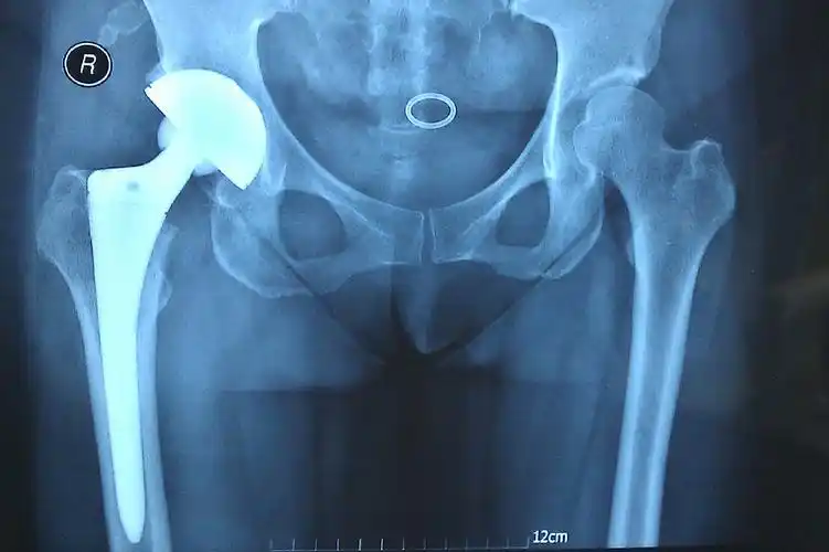 人工髋 关节置换 术后的x光片