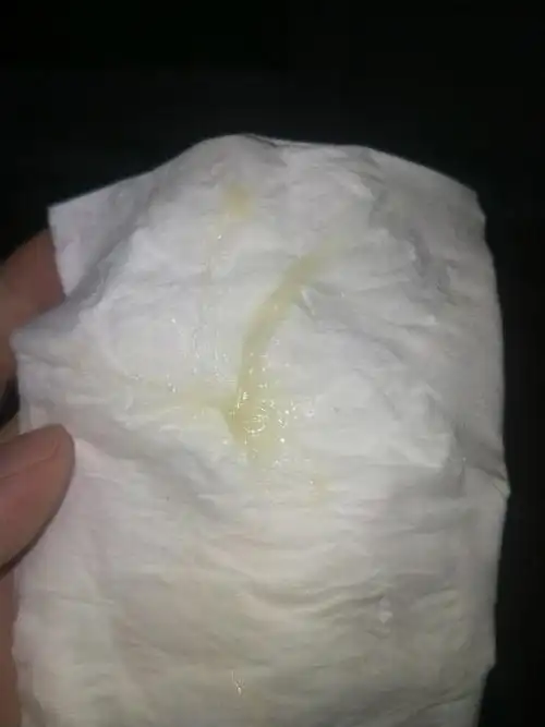 怀孕一直都是下面有黄色分泌物 有图勿进