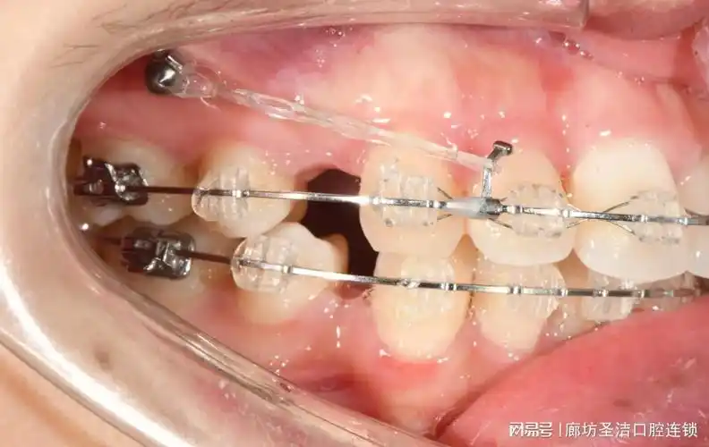 在廊坊什么样的牙齿需要用骨钉