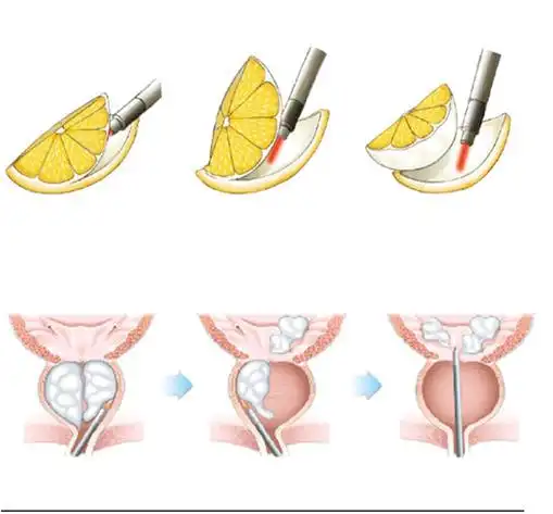 前列腺增生知多少 - 好大夫在线