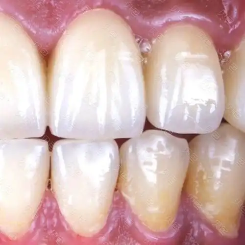 【全瓷冠门牙修复】对比案例
