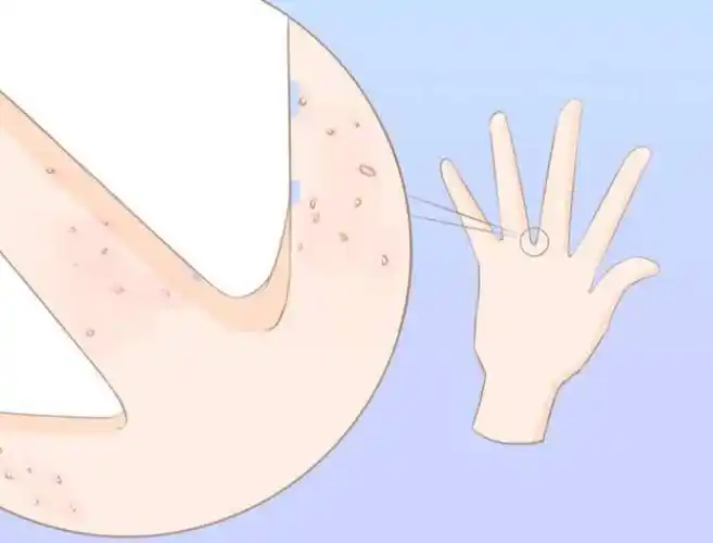 疥疮是一种什么皮肤病,该怎么治疗?_外用_药物_良好效果