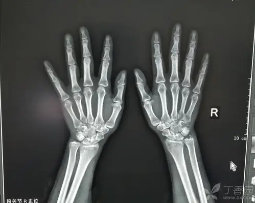 右尺骨茎突撕脱骨折?