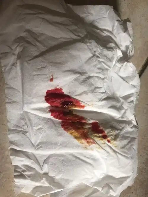 男,今早发现拉大便出血,中午也是.