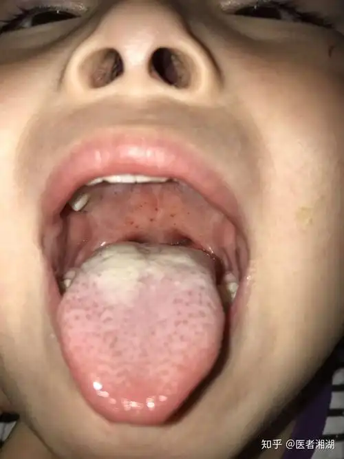 手足口不用惊慌可以中药泡浴