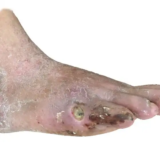 出现溃疡坏疽,慕名前来长海医院血管外科袁良喜副教授专家门诊就诊