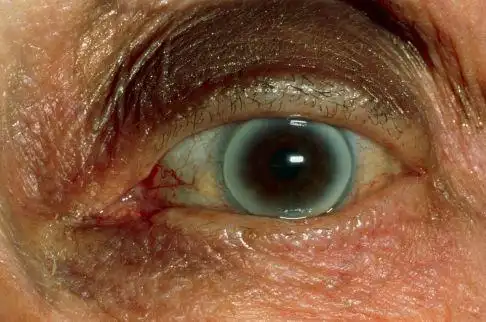 中老年人黑色的眼球边缘出现银白色的圆环,这在临床上被叫做"老年环"