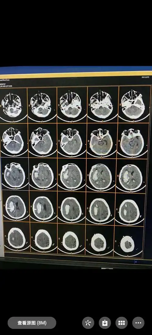 患者:沈淑春,女,60岁,右侧基底节区脑出血,呈嗜睡状态