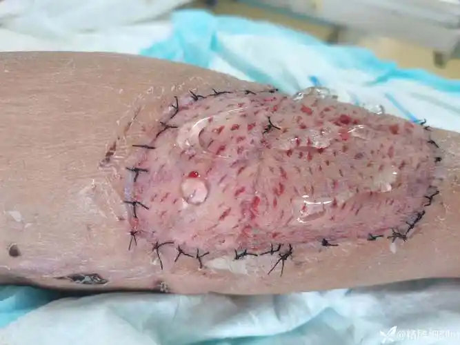 小腿后侧组织缺损vsd辅助游离植皮