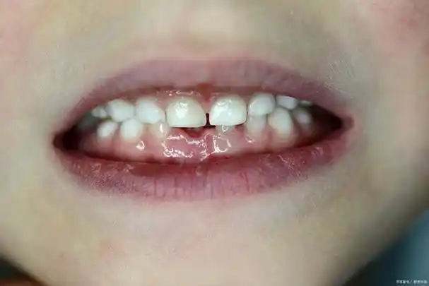 可能是饮食原因,慢性唇炎,先天性心脏病等原因导致的,患者可以根据